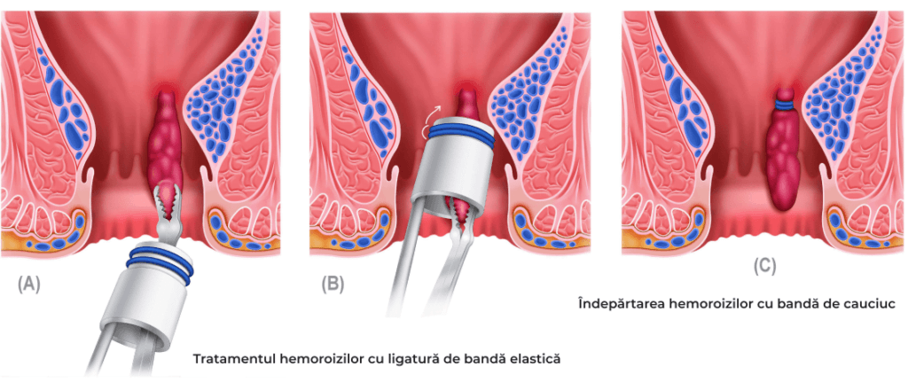 tratament hemoroizi cu ligatura de banda elastica