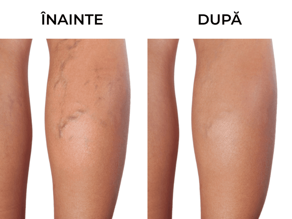 rezultate tratament varice