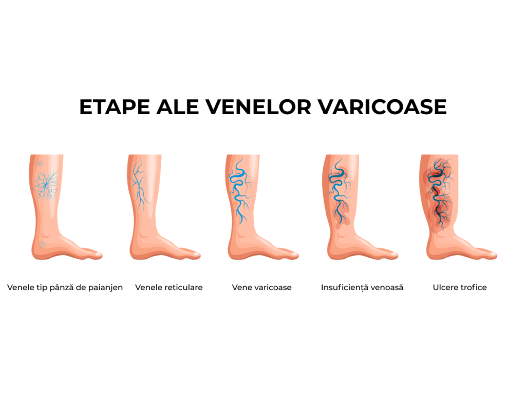 etape vene varicoase