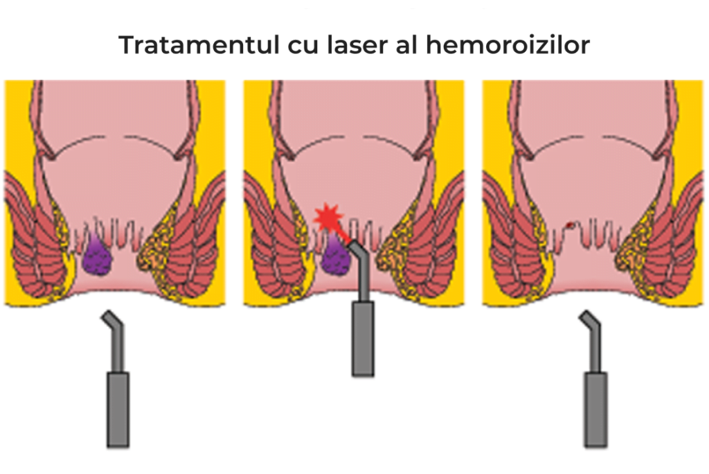 tratament laser hemoroizi