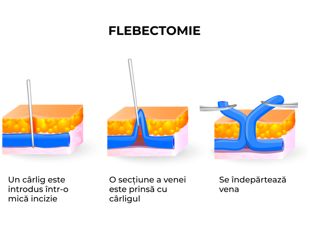 flebectomie