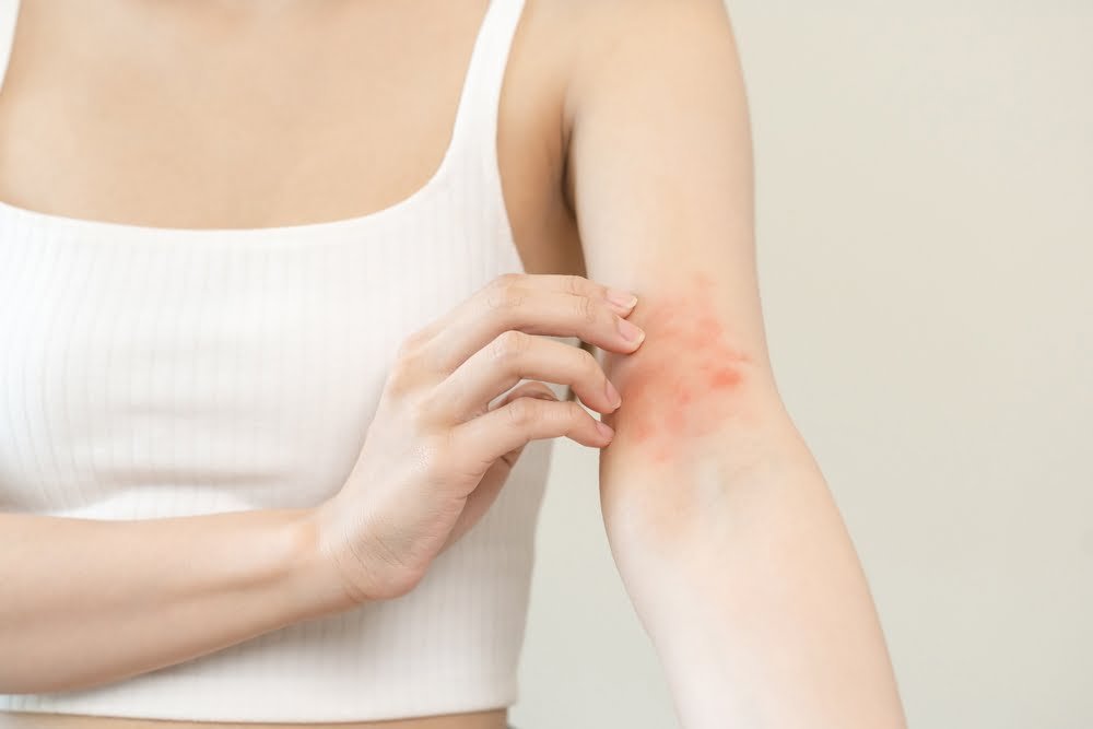Care sunt cauzele eczemei