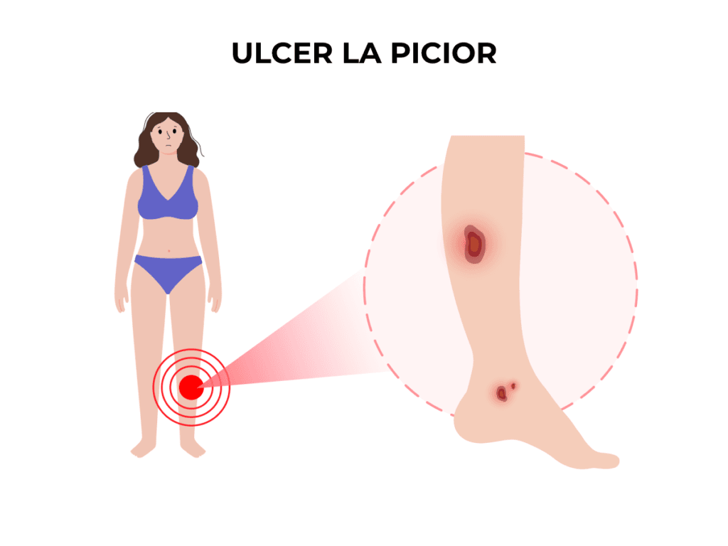 ulcer varicos