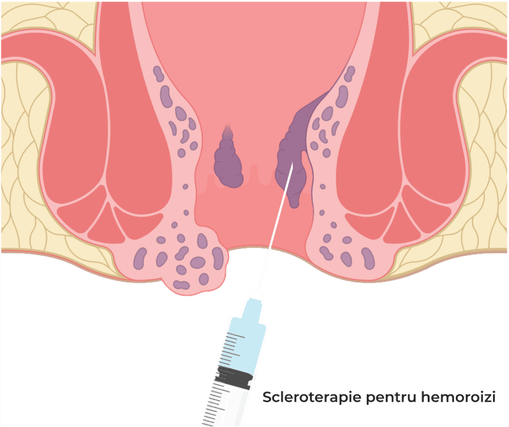 scleroterapie pentru hemoroizi
