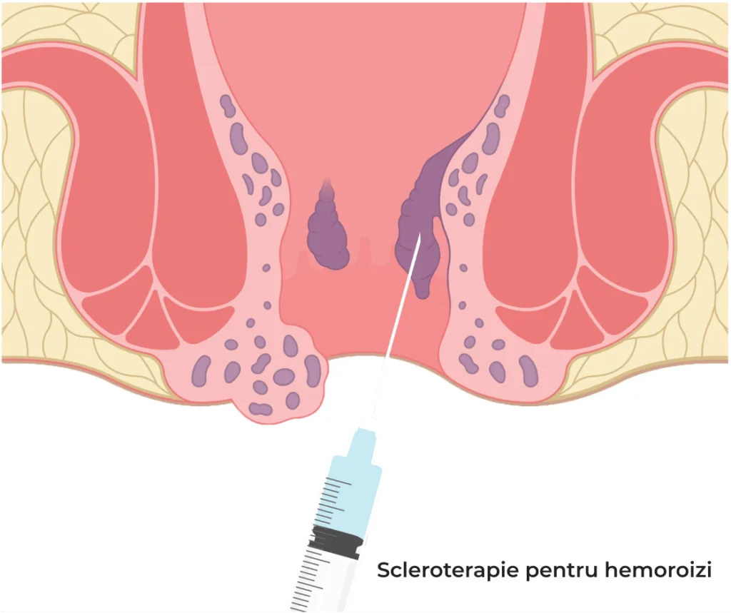 scleroterapie pentru hemoroizi