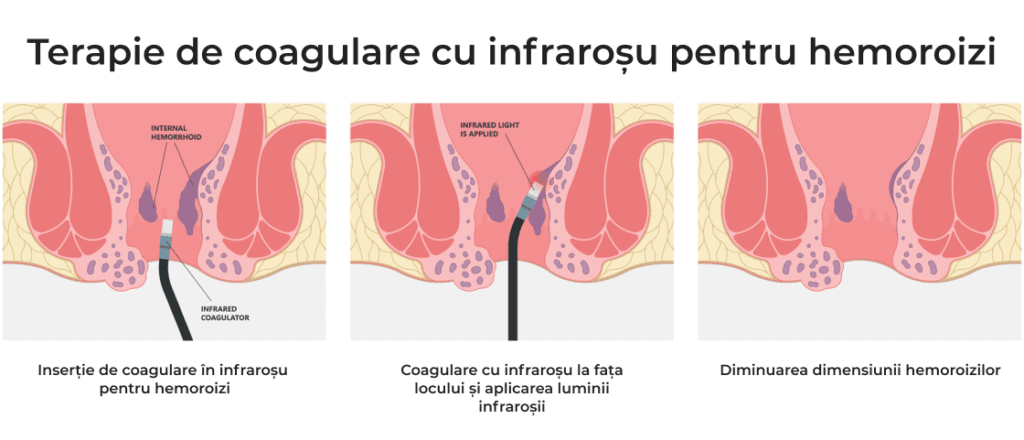 terapie cu coagulare hemoroizi