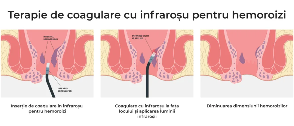 terapie cu coagulare hemoroizi