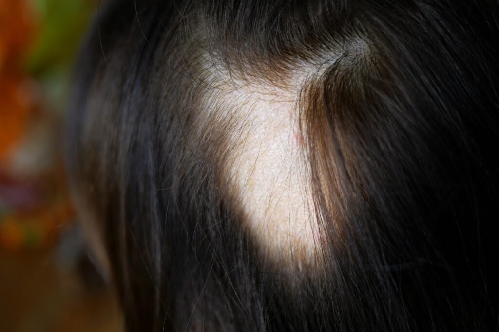 alopecia areata