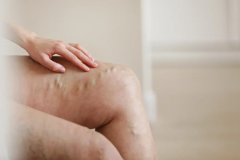 De ce cremele și gelurile nu pot vindeca varicele deja formate