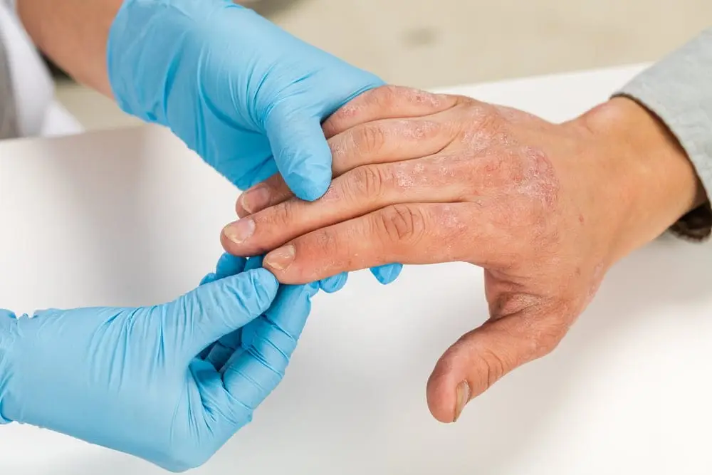 Cum se trateaza eczema