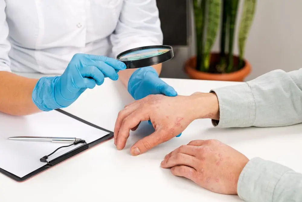 Consult psoriazis