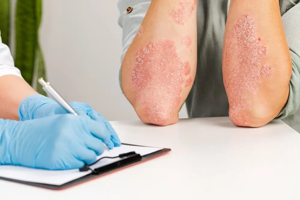 Tratament psoriazis