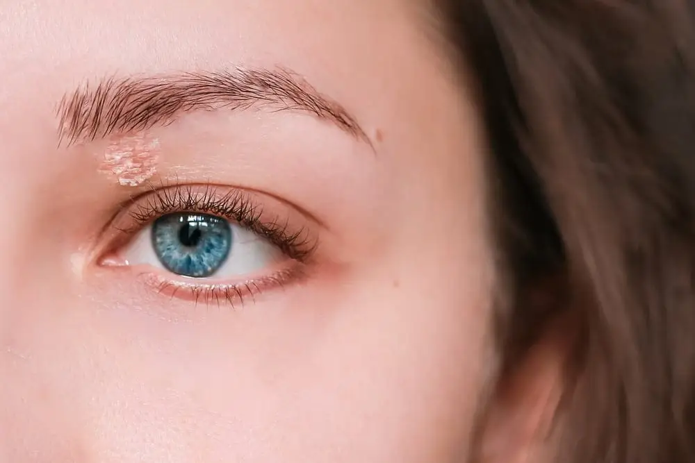 Psoriazis facial