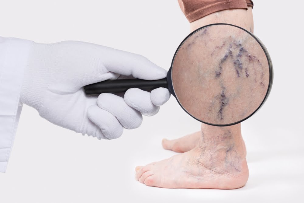 Care sunt cauzele apariției varicelor?