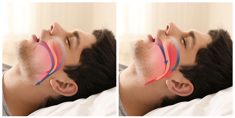 Respirație normală vs apnee de somn